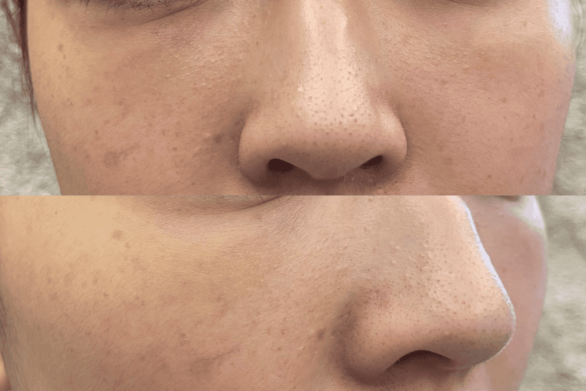 【台北醫美診所】賦真妍皮膚專科│鉺雅鉻雷射全紀錄與心得│治療