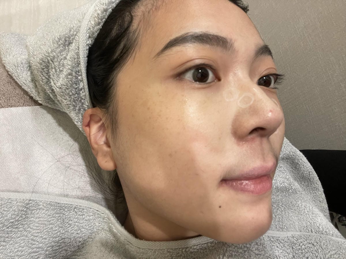 【台北醫美診所】賦真妍皮膚專科│鉺雅鉻雷射全紀錄與心得│治療