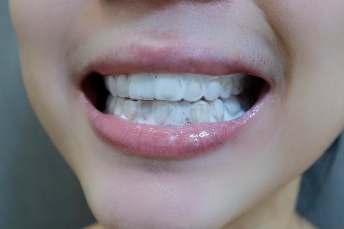 【新竹牙醫推薦】你知道如何有效預防蛀牙嗎? ｜洗牙、個人 氟