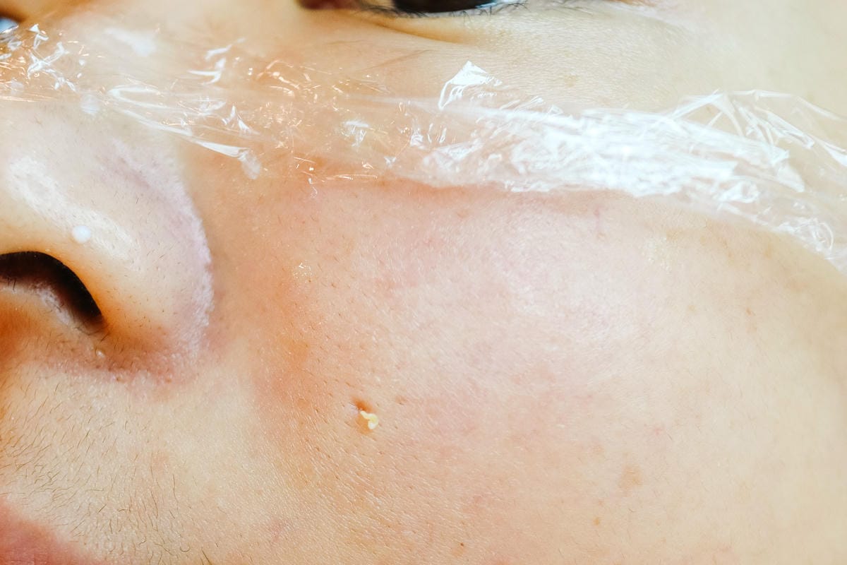 【新北板橋做臉】NINIS STUDIO 美肌館│問題肌膚改