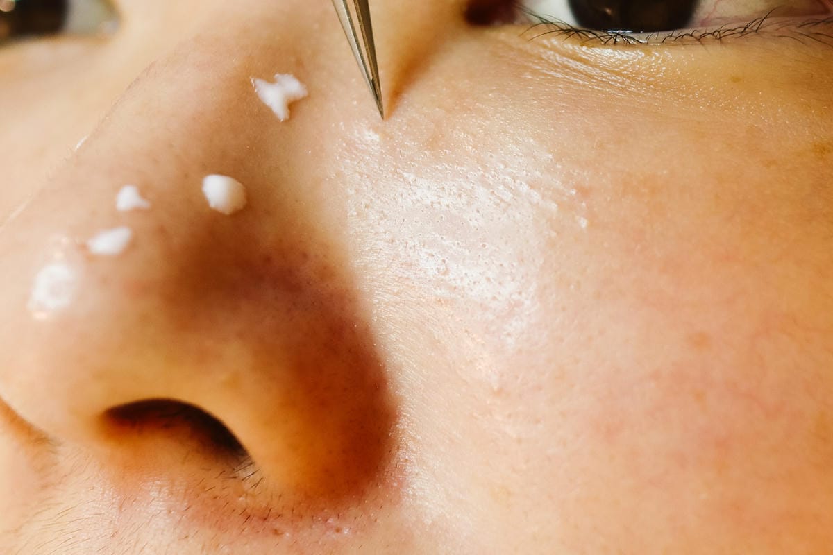 【新北板橋做臉】NINIS STUDIO 美肌館│問題肌膚改