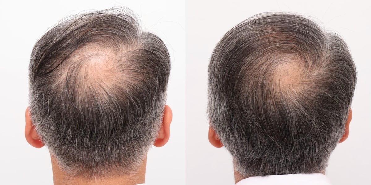 【PRP生長因子蘊髮】植診所 Le Bourgeon│帶爸爸 【PRP生長因子蘊髮】植診所 Le Bourgeon│帶爸爸