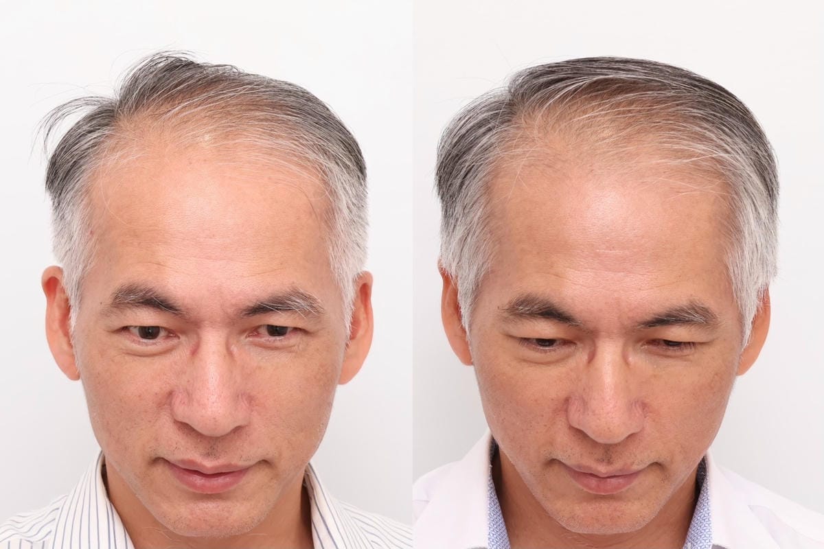 【PRP生長因子蘊髮】植診所 Le Bourgeon│帶爸爸 【PRP生長因子蘊髮】植診所 Le Bourgeon│帶爸爸